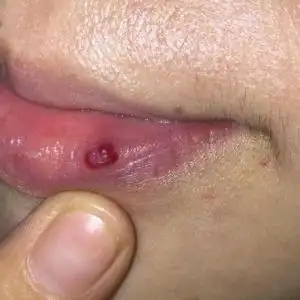 舌头血管瘤的类型