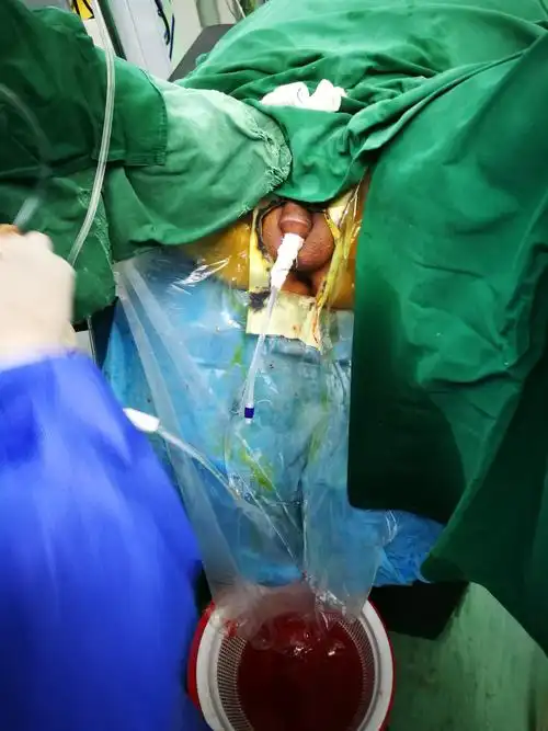 11月26日介休市人民医院成功开展扩开术一台