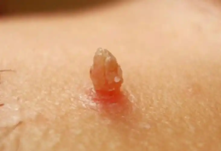 身上长了小肉疙瘩到底怎么回事有些会传染你最好警惕