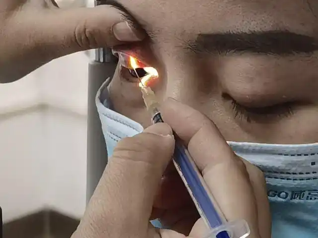 小小一颗眼结石,危害巨大,竟然卡的眼睛不适三个月,最后弄得划伤眼角