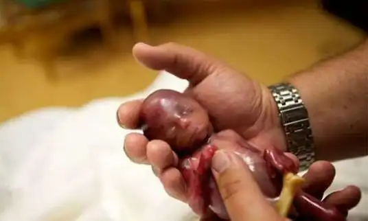 他们忍痛公开5个月早产儿照片看完后都心碎了