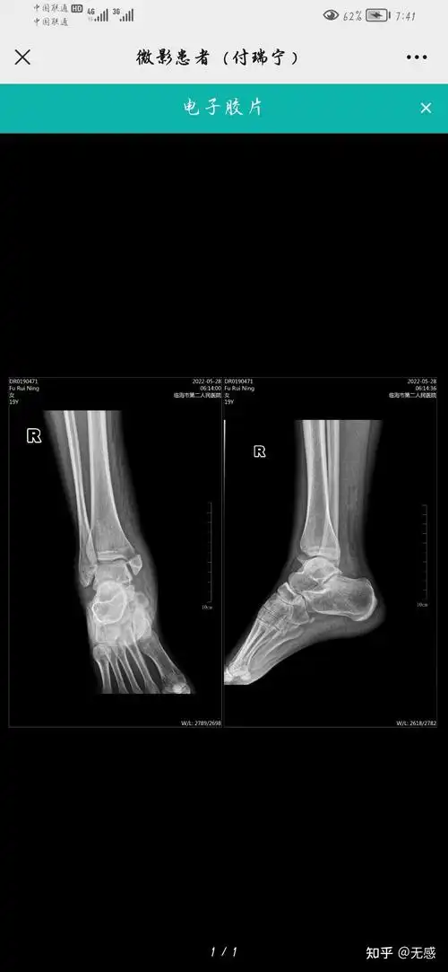 记录一下右脚内踝骨折过程吧