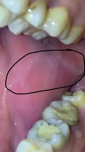 关于良性口腔白斑图片的配图及描述