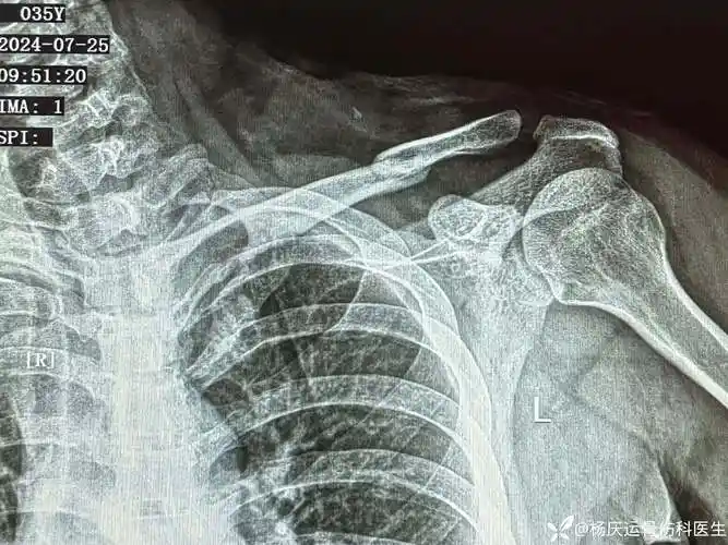 成人锁骨骨折,这样治疗能接受吗