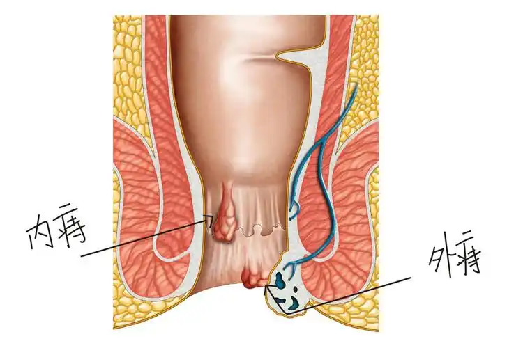 内外痔疮的区别及图示_妙手医生