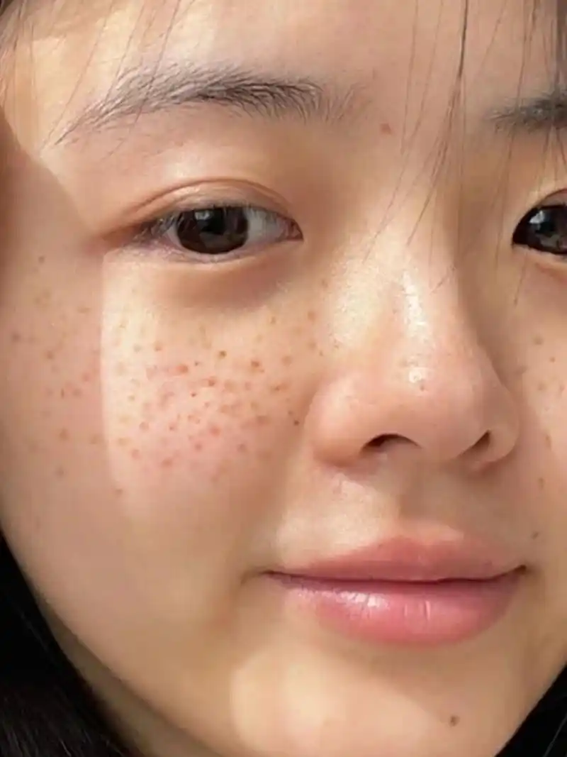 谁懂,之前脸上的斑点化妆都遮不住,现在脸上干干净净的真的很爱了