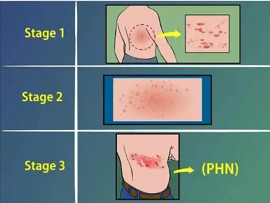 蜘蛛蛋蜘蛛蛋是什么梗蜘蛛蛋皮肤病有什么症状图
