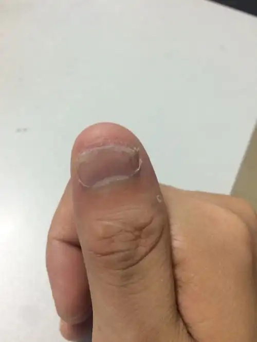 如图,有谁知道手指甲这样空,是怎么回事吗?