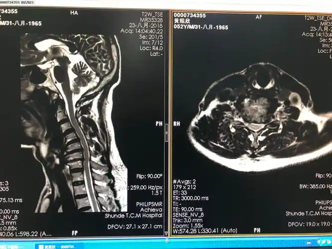 混合型颈椎病的手术治疗_提示