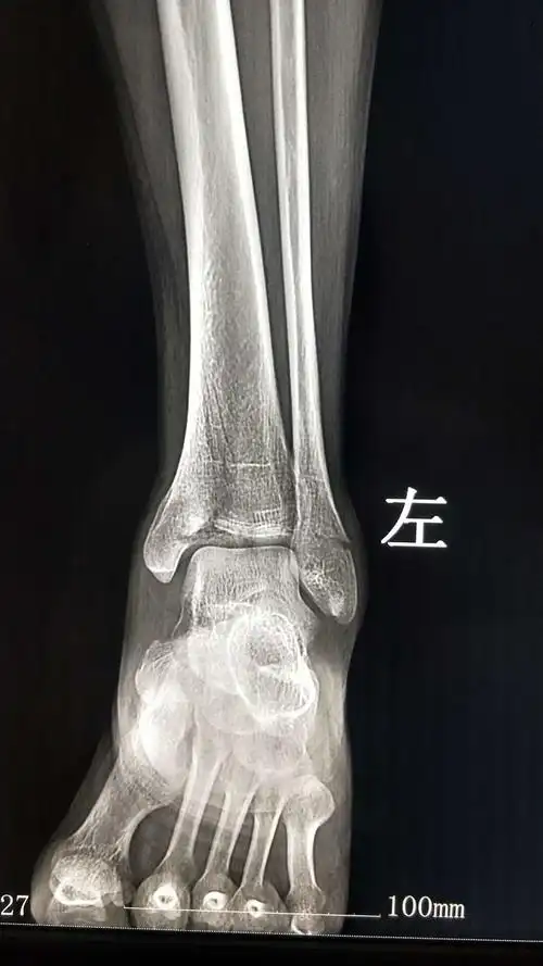 术后x线片术后切口现患者已出院,切口愈合可,左小腿可借助拐杖下地