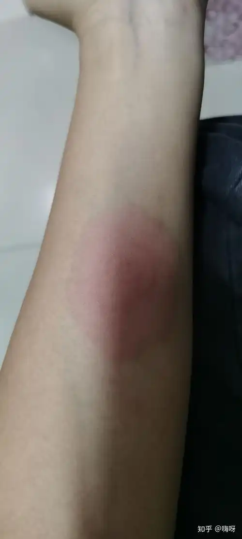 结核皮试出现如下状况是啥结果呢