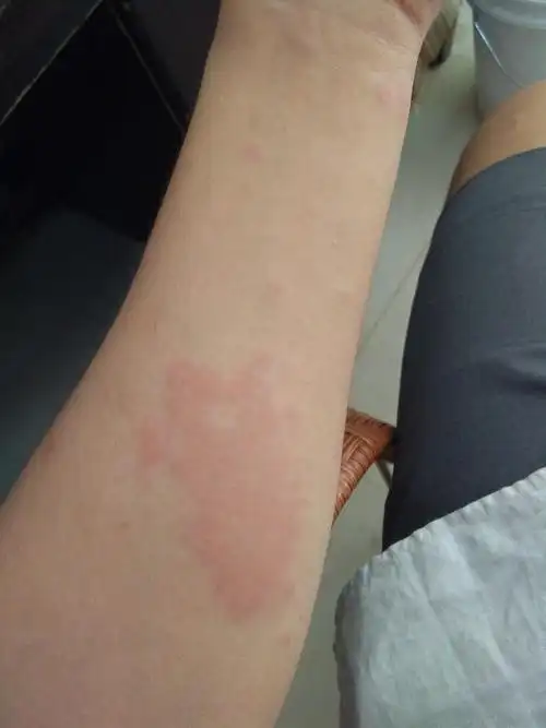 又严重了今天早上起来全身都是风团