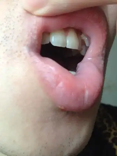 问:嘴唇两边长了成群的白色粒粒,不痛不痒,也不知道什么时候长的,今天