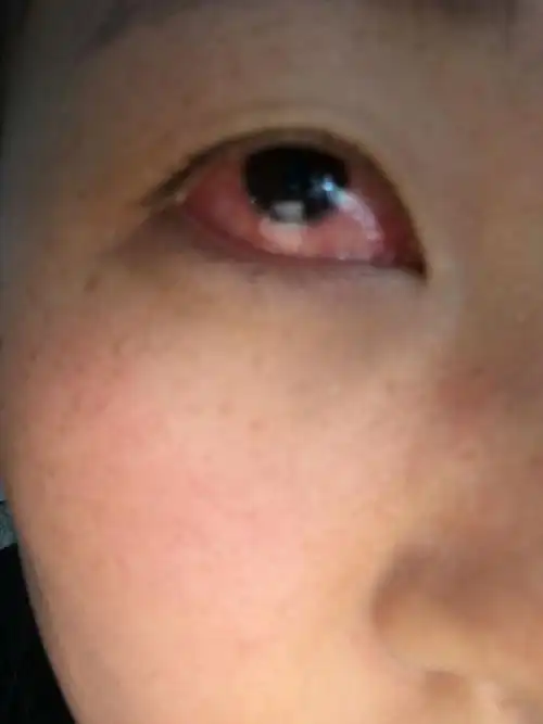我眼睛全是红血丝,疼,流泪,怕光怕风,有胀疼的感觉,近视眼,视