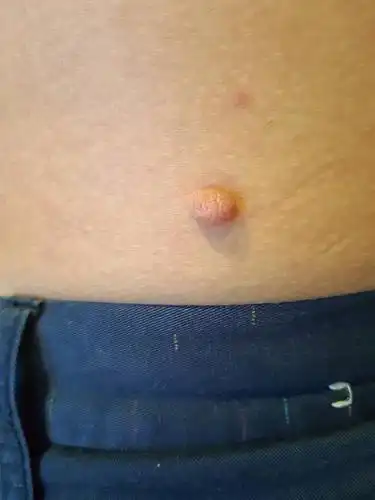 身上腰后部长了一粒肉圪塔,不知道这是什么原因.