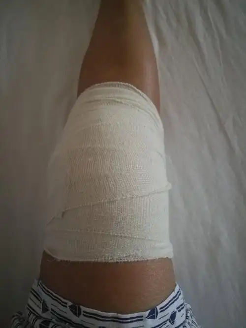 右膝外侧半月板损伤手术记