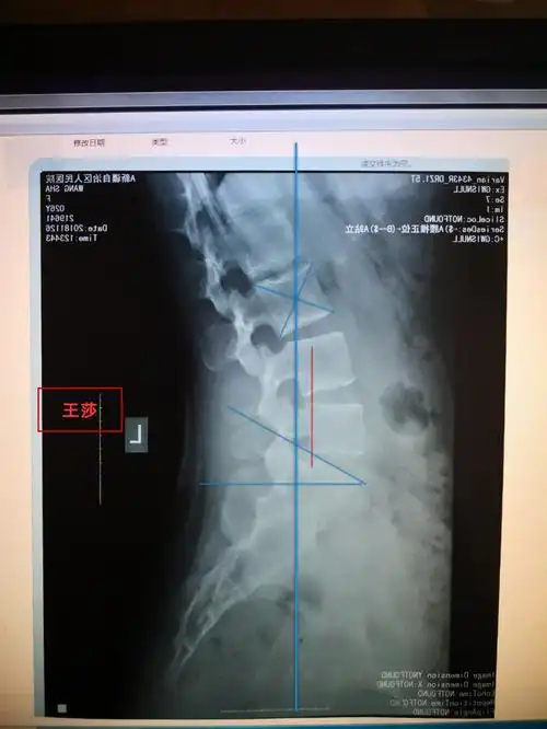下胸椎过直,胸腔前倾 4.腰骶角大于30度过大,腰椎t5半脱位,腰椎前移.