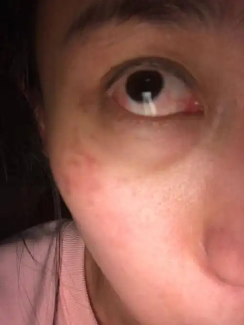 眼睛疼,头疼一下午,晚上就这样了-系统性红斑狼疮康复圈-觅健