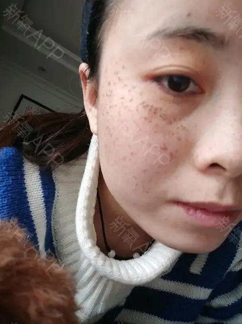 遵义激光祛斑好不好_效果图_明天有梦还要飞激光祛斑术后第1天_新氧