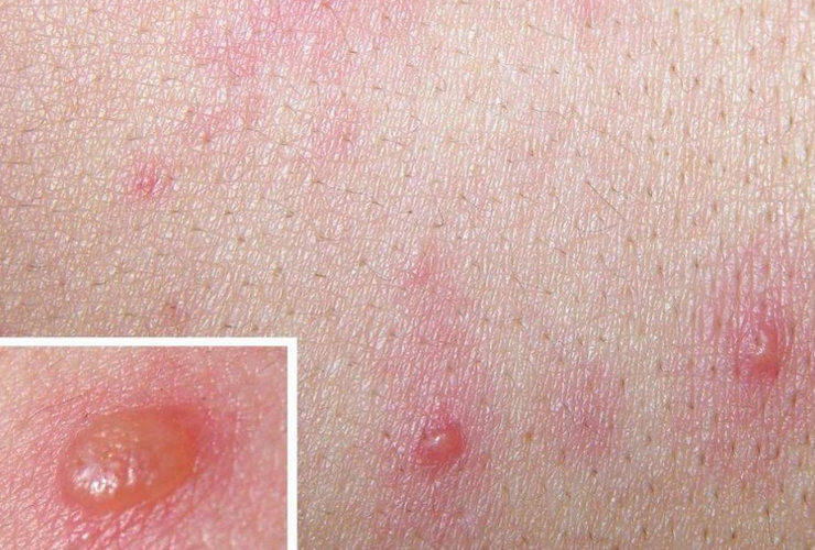 【水痘刚开始的样子图片】_初期表现_传播途径_苹果绿