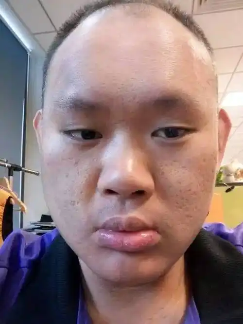 sy9年,容貌变丑,痛下决心戒色 | 爆照