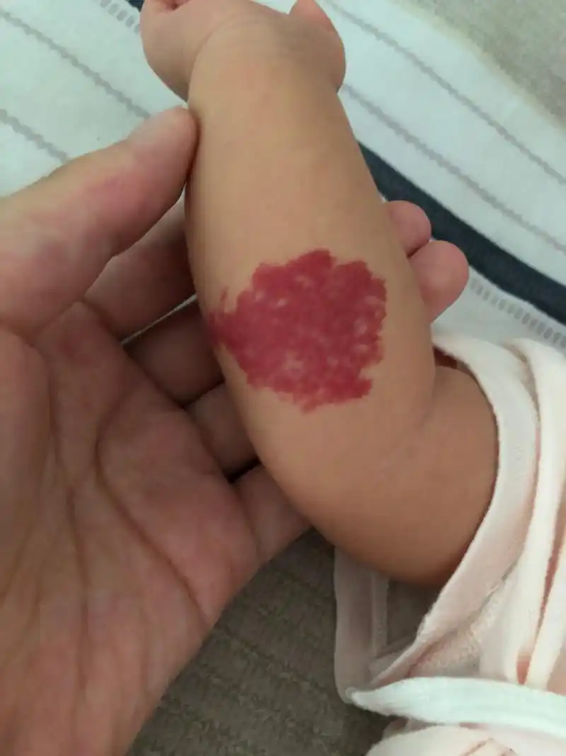 才一个月就长这么大的血管瘤～我可怜的闺女