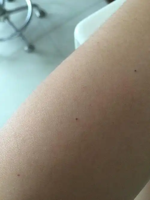 胳膊上长满了这种皮下出血点好多小的密密麻麻的拍不出来不会是白血病