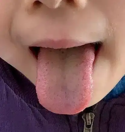 我眼中的舌诊白腻苔2