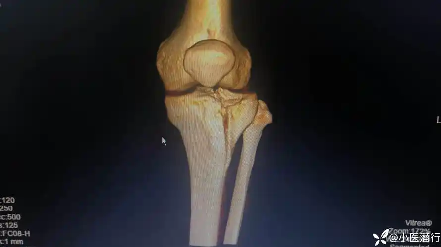 小医-胫骨平台塌陷劈裂骨折,切开复位内固定1例