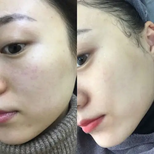 m22王者之冠(光子嫩肤)