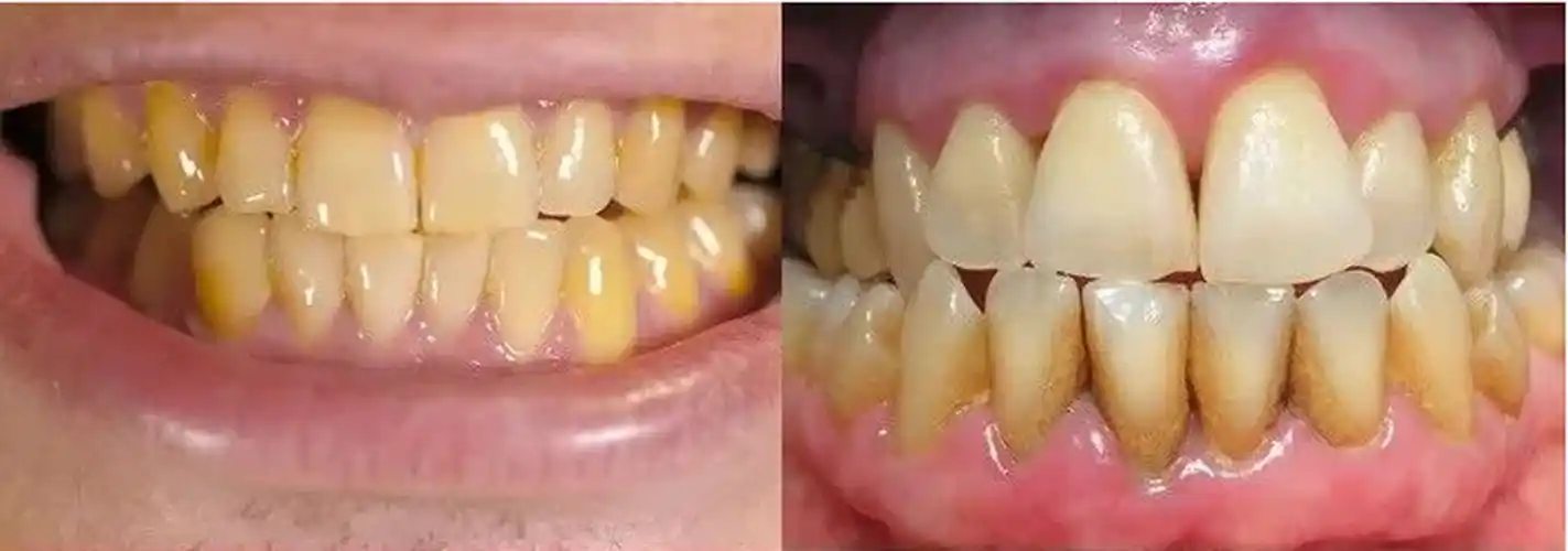 一口大黄牙让人"美感"全无!牙齿美白,真有那么难吗? - 知乎