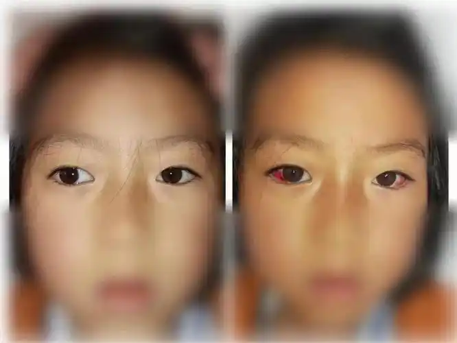 跨越百里昆明眼科医院公益救助贵州3名斜视儿童