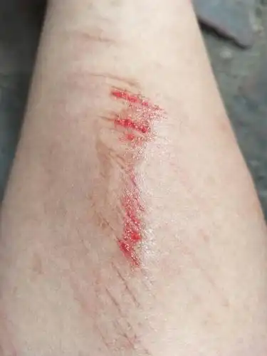 今天不小心摔了一跤