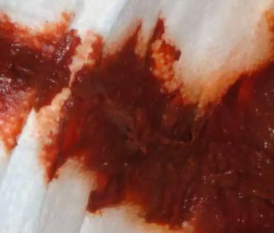 首先排除孩子摄入食物的影响,比如火龙果,甜菜.