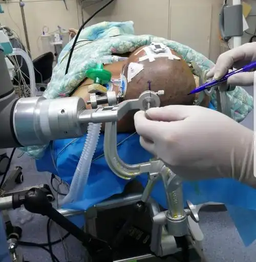 神经外科睿米手术机器人是微创治疗高血压脑出血的一种新方法.