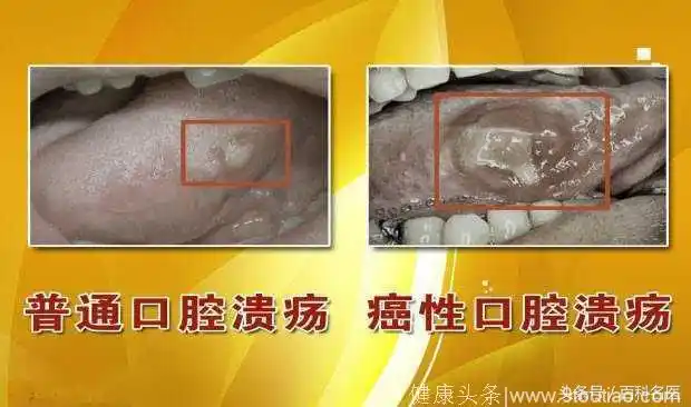 口腔溃疡总是长在同一个地方,可能是口腔癌吗?