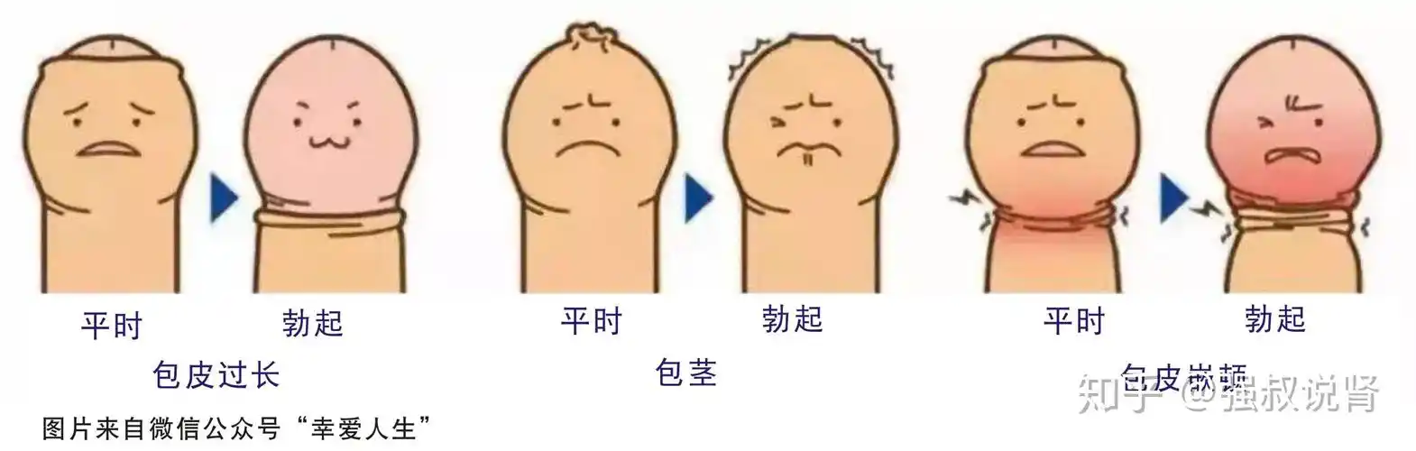 包茎龟头突然漏出来,包皮缩不回去,扣得很紧,很难受,怎么办? - 知乎