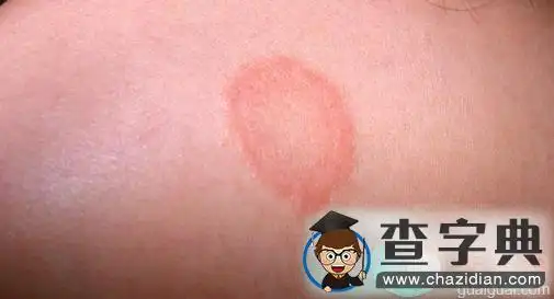 宝宝长了皮癣怎么办