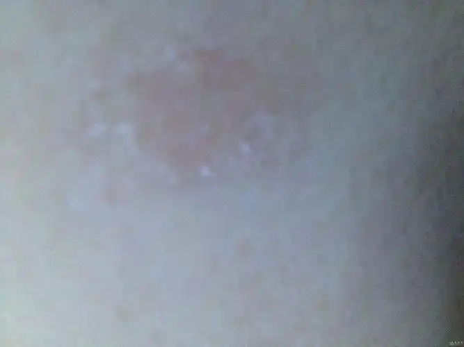 请各位老师帮忙看看这个是什么癣,有图的