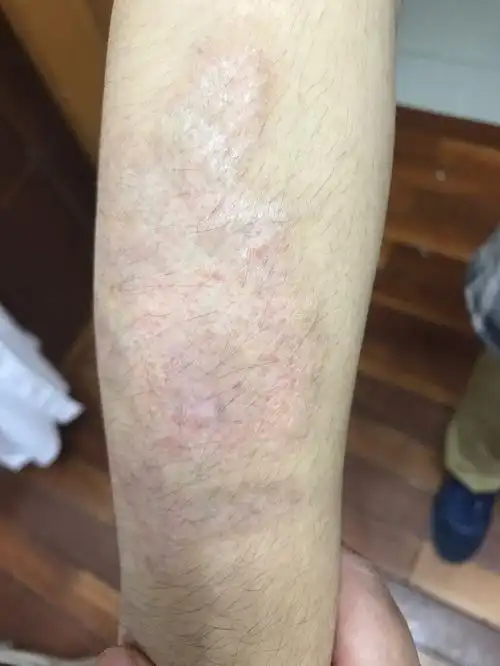 洗纹身案例持续更新中!