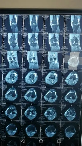 关节镜下前交叉韧带重建术独立完成,我院骨一科微创治疗从此迈向新