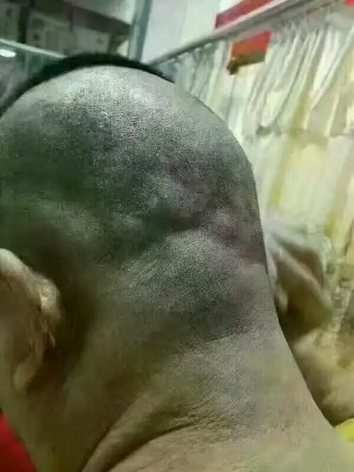 这个顾客全身有50多个脂肪瘤