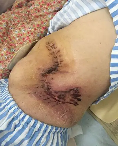 缝合后的伤口(没有植皮)