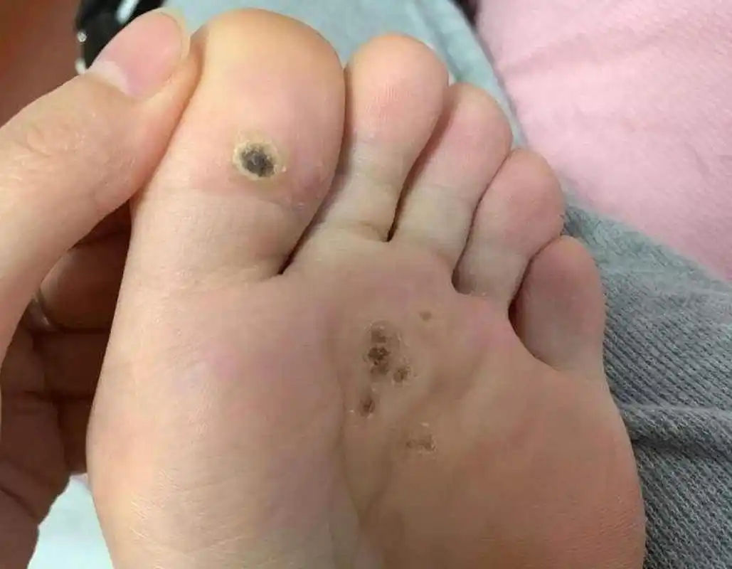 跖疣可以自愈吗?