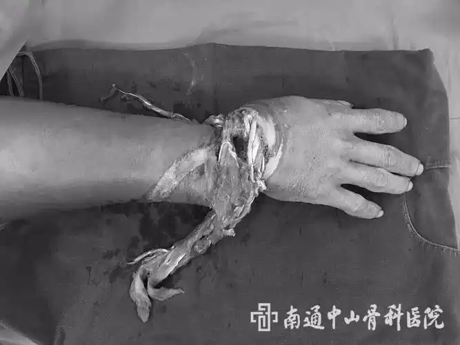 【案例】工作疏忽致右腕部离断 中山医生妙手成功再植_断肢