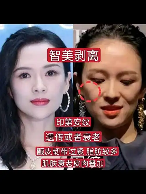 蒋欣的印第安纹|智美剥离
