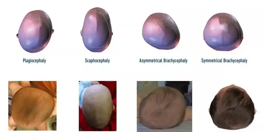 婴儿先天性头颅畸形宇航博士矫正帮助你_基本分析