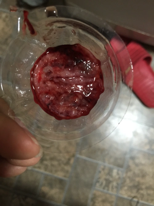 [2015年12月妈妈帮]这是流产了吗,有图慎入