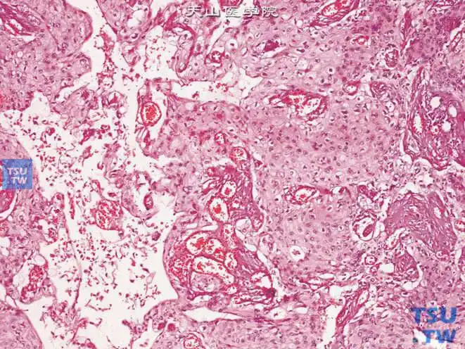 尿道鳞癌.可见细胞间桥