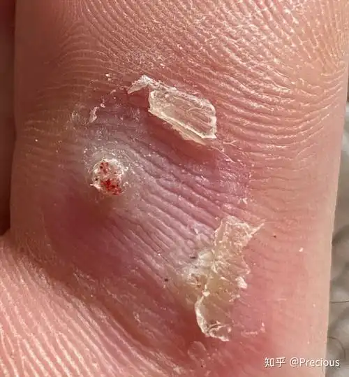 跖疣治疗过程 快完全治愈了(多图 高能 慎点) - 知乎